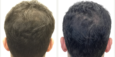 38 year old man treated with Rogaine - This is a 38-year old male with progressive, androgenetic hair loss starting at about age 18. He was on finasteride for about 10 years when it first started but stopped at about age 28 because he just felt that he didnt want to be on oral medication anymore. Unfortunately, though, once he stopped the finasteride, his hair started falling out.More recently hed started daily minoxidil which was working well to prevent any more hair loss, but as expected, it didnt do anything to regrow the deepening recessions on both sides of his hairline. He was seeking restoration with surgery. You can really see those recessions once we shaved his head just prior to getting started. At the same time, he wanted a little more density behind his hairline in the frontal scalp, as well as a few grafts scattered over the crown, just to add a slight bit of density there.He had a 2461 graft FUE, with most of the grafts allotted to filling those recessions on either side of his hairline. We also added a few through the remainder of the frontal scalp and just a small amount in the crown.Hes had a great result! The recessions are restored and his hairline looks really natural! Hes still using his daily minoxidil to prevent ongoing hair loss and this is the kind of restoration that will age with him really naturally for decades to come. Even though we extracted more than 2400 grafts, weve done it in such a way that his donor area still looks really full. Youd really never be able to tell that this patient had a hair transplant!