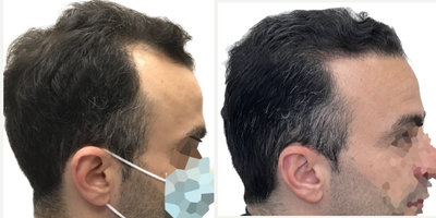 38 year old man treated with Rogaine - This is a 38-year old male with progressive, androgenetic hair loss starting at about age 18. He was on finasteride for about 10 years when it first started but stopped at about age 28 because he just felt that he didnt want to be on oral medication anymore. Unfortunately, though, once he stopped the finasteride, his hair started falling out.More recently hed started daily minoxidil which was working well to prevent any more hair loss, but as expected, it didnt do anything to regrow the deepening recessions on both sides of his hairline. He was seeking restoration with surgery. You can really see those recessions once we shaved his head just prior to getting started. At the same time, he wanted a little more density behind his hairline in the frontal scalp, as well as a few grafts scattered over the crown, just to add a slight bit of density there.He had a 2461 graft FUE, with most of the grafts allotted to filling those recessions on either side of his hairline. We also added a few through the remainder of the frontal scalp and just a small amount in the crown.Hes had a great result! The recessions are restored and his hairline looks really natural! Hes still using his daily minoxidil to prevent ongoing hair loss and this is the kind of restoration that will age with him really naturally for decades to come. Even though we extracted more than 2400 grafts, weve done it in such a way that his donor area still looks really full. Youd really never be able to tell that this patient had a hair transplant!