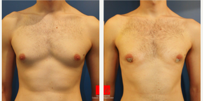 Gynecomastia - Male Breast Reduction - Gynecomastia - Male Breast ReductionReduction of excess fat and skin