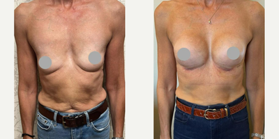 Woman treated with Breast Augmentation, Motiva Breast Implants, Breast Lift, Breast Implants - Breast Augmentation Ergonomix 2 E2SM 200cc Motiva Subfascial (1 Week)