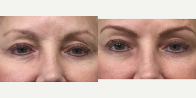 55-64 year old woman treated with Permanent Makeup - MicroBlading Before and After pictures by Dr. Deborah Sillins of Rejuvene Plastic Surgery in Northern Kentucky and Cincinnati.