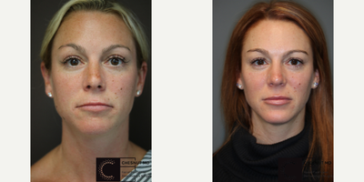 Hyaluronidase - Facial balancing of lips and jawline.