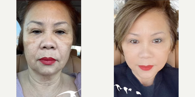 Woman treated with Facelift - FACELIFT TRANSFORMATIONIncredible how much improvement she's seen in such a short amount of time.This is the reason I love the deep plane facelift technique -- we have literally sculpted a decade+ of age away.Note -- although these photos were taken in the same place and by the same person, you can see the lighting on the right is more forgiving and she is wearing makeup there, so these photos likely overstate her improvement. That said, I generally tell patients to wait 2 months until they are photo-ready after a deep plane facelift, and I think it's important to share patient progress (provided it's chronicled honestly) at all stages of the recovery journey.Her results will continue to get better and better.