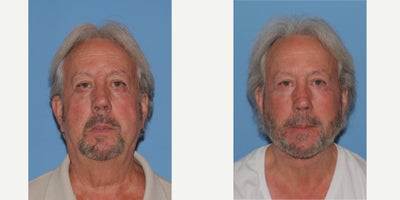 65-74 year old man treated with Deep Plane Facelift, Facelift - This patient came to me after having his eyes done by another surgeon. He was incredibly unhappynot only with the physical results but also with the function. After his first blepharoplasty procedure, he experienced all kinds of issues with his eyes. From constantly feeling like his skin was being pulled to struggling to keep his eyes hydrated, the procedure had taken a toll on his confidence and mental health.While he wasnt having issues with how his eyes physically looked, that was not the case with his neck, which was almost non-existent. In his pre-op pictures when he is looking down you can actually see his neck resting on the top of his sternum. This is a man with a naturally strong jawline, but you couldnt appreciate it because of how much excess skin was in the way.Here are the patients procedure details;Age: 71 years youngSedation: Twilight sedation Preservation Face & Neck Lift Temporal Brow Lift Fat Grafting to FaceRecovery: 7 months post-opOR Time: 5.5 Hours