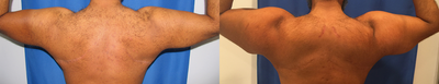 Man treated with Bicep Implants - Man treated with Bicep Implants