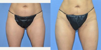 45-54 year old woman treated with BodyTite - 46 year old female shown 6 months after BodyTite liposuction to her abdomen, inner thighs, knees, and bra rolls and regular liposuction to her flanks and outer thighs.