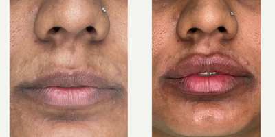 25-34 year old woman treated with Lip Fillers, Juvederm - patient treated with 1 syringes of juvederm ultra plus xc
