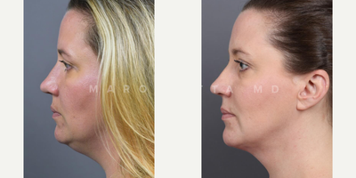 Woman treated with Renuvion - Submental Liposuction with Renuvion. Witness the stunning before-and-after photos of our satisfied patient!Our patient underwent submental liposuction, a minimally invasive procedure targeting excess fat beneath the chin. But thats not all, we took it a step further with Renuvion, a cutting-edge technology for skin tightening.Whats submental liposuction? This procedure precisely targets and removes stubborn fat, revealing a more defined and contoured neck and jawline.Whats Renuvion skin tightening? Using a unique combination of helium plasma and radiofrequency energy, Renuvion tightens and rejuvenates the skin, ensuring a smoother and more youthful appearance.