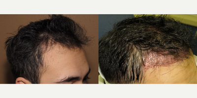 Woman treated with Hair Loss Treatment - FUE Nograft hair transplantation