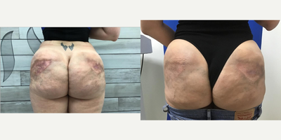 35-44 year old woman treated with Carboxytherapy - This patient had illegal silicon injections at a location not assocated with Evolution MD. The injections caused her skin to have pigmentation problems and she came to Evolution MD to have that fixed. After 8 months of carboxytherapy, her pigmentation has increased tremendously.