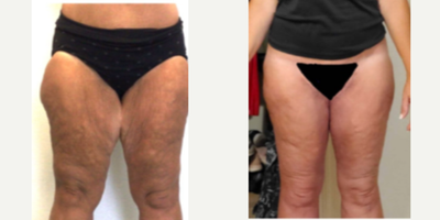 35-44 year old woman treated with Liposuction - Tired of feeling self-conscious about the appearance of your thighs? Dr. Meegan Gruber's thigh lift can help you achieve a smoother, more toned appearance. The before and after photos of Dr. Gruber's patients speak for themselves - this procedure can make a transformative difference in the contours of your thighs, giving you a newfound confidence in your body. Trust Dr. Gruber's expertise and experience to give you the results you deserve. Book your appointment today and take the first step towards the body you've always wanted!