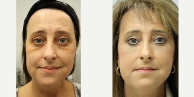 45-54 year old woman treated with MiXto Laser - This breakthrough technology resurfaces with faster healing and patients typically experience only one week of social downtime post procedure. Results are immediate shrinkage of damaged skin, softening of lines and wrinkles, smoothing of acne scars and improved texture and skin tone. New collagen production occurs for up to six months following treatment, making this our most effective laser rejuvenation.