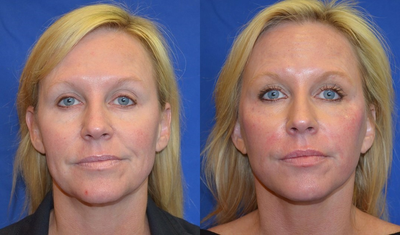 40-49 year old woman treated with Neck Lift - 40-49 year old woman treated with Neck Lift