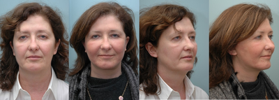 Facial Reconstructive Surgery  - 
	Facial Reconstructive Surgery
