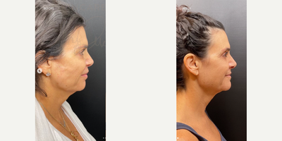 Woman treated with Sylfirm X, Renuva - SylfirmX + Renuva are an excellent combo! Lift, improve texture and tone of your skin with some of our favorite treatments