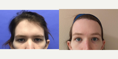 Patient treated with Brow Lift, Forehead Reduction - Forehead Lift, Hairline Lowering, Supra Orbital Bone Reduction and Contour - 25 to 34 year-old female patient is 6 months post-op from Facial Feminization surgery. Her procedures included: Forehead Lift, Hairline Lowering, Supra Orbital Bone Reduction and Contour, Septorhinoplasty (closed) with Cartilage Grafts and Weirs, Chin Reduction and Contour, Soft Tissue to Nasolabial Folds, and Thyroid Cartilage Shave.