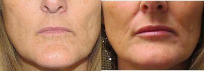 Lip Augmentation | Lip Implant for this 53 Year Old Female - Before and after pictures of Lip Augmentation with Perma Lip Facial Implant. This is a very soft but solid silicone implant.  It is not liquid silicone and is not injected.  The lip implant placement requires a 30 minute in office minor surgery under local anesthesia.