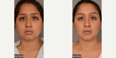 Woman treated with Chin Liposuction - Woman treated with Chin/Neck Liposuction and Buccal Fat Removal. Patient is shown before and 3 months post-op.