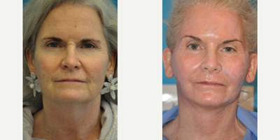 Woman treated with Laser Resurfacing - Woman treated with Facelift, Neck Lift, Brow Lift, and Laser Resurfacing. Patient is shown before and less than 3 weeks post.op.