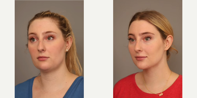 Woman treated with Smart Lipo - Woman treated with Chin Liposuction through Smart Lipo. Pre-op, patient had fullness behind her chin since childhood, regardless of her weight.