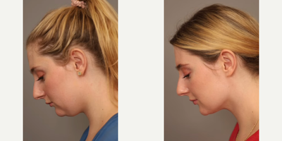 Woman treated with Smart Lipo - Woman treated with Chin Liposuction through Smart Lipo. Pre-op, patient had fullness behind her chin since childhood, regardless of her weight.