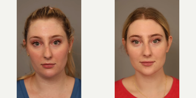 Woman treated with Chin Liposuction - Woman treated with Chin Liposuction through Smart Lipo. Pre-op, patient had fullness behind her chin since childhood, regardless of her weight.