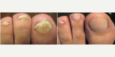 45-54 year old man treated with Laser Nail Fungus Therapy - The ND Yag 1064 wavelength is the Gold Standard in medical-grade lasers. The FDA has approved a laser known as ND Yag for the treatment of Nail Fungus!A series of quick, safe and painless treatments have proven effective at killing nail fungus on the toes or the fingers.This versatile laser is useful for many other indications as well, but in the treatment of nail fungus allows us to apply just enough bulk heating at the perfect depth to kill the fungus.ClearSteps is a revolutionary new procedure for treating Onychomycosis. It is a non-invasive laser procedure to treat the affected nail and skin. It is simple, quick, safe and effective.