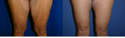 35-44 year old woman treated with Thigh Lift - After losing 131 pounds, this patient in her late 30s was left with wrinkly thighs. She wanted to get rid of the loose skin of her thighs after massive weight loss. Dr. Katzen performed a thigh lift in Beverly Hills to get rid of her loose skin. She is extremely happy with her results. She was also treated with a 360 body lift to remove the excess skin of her abdomen, hips, and backside.