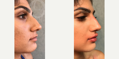Woman treated with Nonsurgical Nose Job - Woman treated with Nonsurgical Nose Job