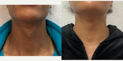 18-24 year old woman treated with Adam's Apple Reduction - this is a young lady who underwent adam's apple reduction.