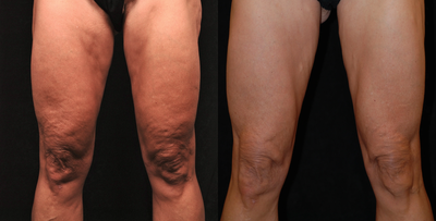 cellulaze - This patient underwent one cellulaze treatment of the anterior and inner thighs