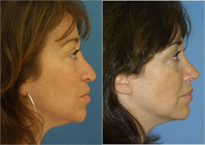 Revision Rhinoplasty - 
	She had undergone a prior nasal surgeries before coming to my practice. She wanted her droopy nose to be elevated and the tip made more narrow. After a 45 minute procedure, her tip was rotated, narrowed and defined.
