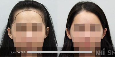 18-24 year old woman treated with Forehead Reduction - Forehead Reduction