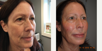55-64 year old woman treated with ALMI - This 59 yo female smoker was interested in facial rejuvenation but not a surgical facelift- the risks that nicotine posed could create too many surgical complications. She had explored a variety of nonsurgical options but was not impressed with the results she had seen with heat and laser devices.She explored further and learned about Regenerative Medicine and the possibility of using her own bodys cells to restore structure and youth to her face. Dr. Mahony is one of the few physicians with the expertise to perform these procedures. One procedure in particular, the ALMI procedure, intrigued her. With this procedure, fat from her own body is processed to separate out the regenerative (stem) cells. These cells, in addition to PRP, are injected into the face for the purpose of not only adding lost volume, but also to regenerate aging cells which renew elastin, collagen, the skin matrix (thickness), hyaluronic acid (moisture) and more. All these natural processes serve to turn back time and return shape, minimize wrinkles, blend in hyperpigmentation and add moisture to the skin.She is delighted with the outcome and very glad to have such a great option outside of face lift surgery!