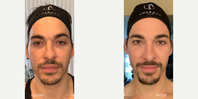 35-44 year old man treated with Skin Rejuvenation Aerify Complexion Kit - 35-44 year old man treated with Skin Rejuvenation Aerify Complexion Kit