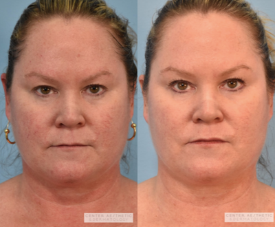 45-54 Year Old Female Treated With Excel V - 1 Month Post Treatment - 1 Treatment of Excel-V to Face & Chest for Redness and Broken Capillaries