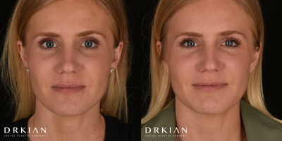 Revanesse Versa HA Filler for Dark Circles Under Eye & Marionette Lines Treatment - Before & After Revanesse Versa HA Filler for Dark Circles Under Eye & Marionette Lines Treatment