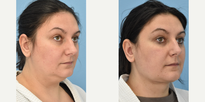 35-44 year old woman treated with Chin Liposuction - 2 months post op! Results will be even better with time. Typically takes 6 months to see the full result.