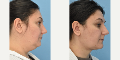 35-44 year old woman treated with Chin Liposuction - 2 months post op! Results will be even better with time. Typically takes 6 months to see the full result.