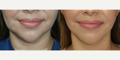 Woman treated with Mini Facelift - One month post-op Mini Lift results on our beautiful patient. This procedure helped to tighten and contour her lower face and jawline.