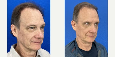 Man treated with Eyelid Surgery, Dysport - Upper and lower blepharoplasty with Dysport on forehead