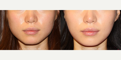 25-34 year old woman treated with Jaw Reduction - Patient requested jaw reduction to soften jawline for a more feminine look.