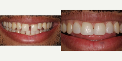 35-44 year old male with unwanted spacing between upper front teeth - This patient was treated with 4 EasySmile(ProVeneers) which were placed without filing down any tooth structure.  The treatment time
was about 1 1/2 hours.