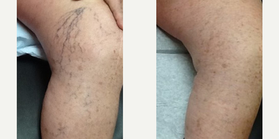 Asclera - Asclera  Leg Vein Treatment. Results 12 Weeks After 2nd Treatment After 4 Treatments