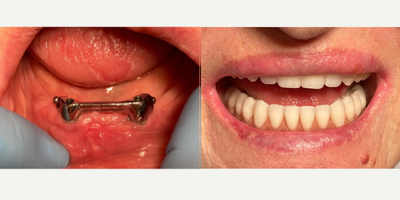 65-74 year old woman treated with Mini Dental Implants - We replaced the old dental bridge of our patient and applied whitening to the whole teeth.