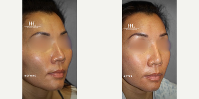 Woman treated with Cheekbone Reduction - Woman treated with Cheekbone Reduction