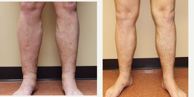 35-44 year old man treated with VenaSeal - Look at all the dilated veins and the swelling of the legs. Both reduced dramatically with bilateral GSV treatment with Venaseal. Patient walked out with a bandaid on.