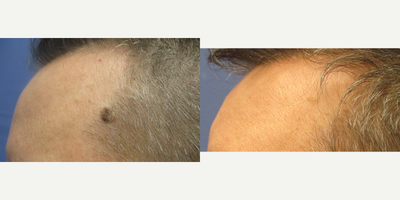 45-54 year old man treated with Mohs Surgery, Photodynamic Therapy - 47 year old male before and 4 months after shave excision of left temple seborrheic keratosis.