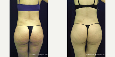 35-44 year old woman treated with Brazilian Butt Lift - 35-44 year old woman treated with Brazilian Butt Lift