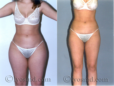 Liposuction - 
	28-year-old woman before and after tumescent liposuction with removal of 12 pounds of fat.
